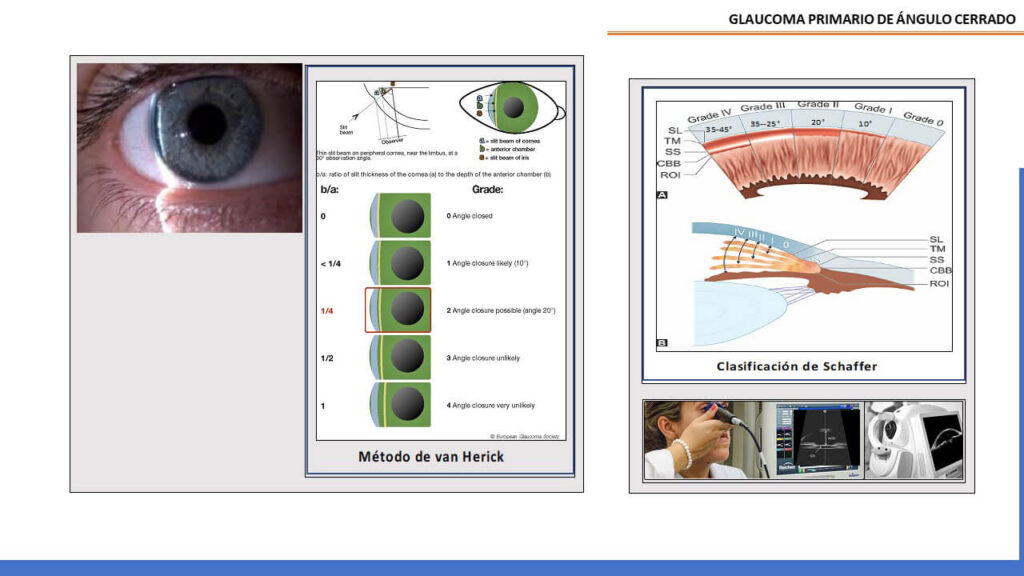 ACTUALIZACIÓN DE GLAUCOMA EN ÁNGULO CERRADO Oftalmologo Quito Dr