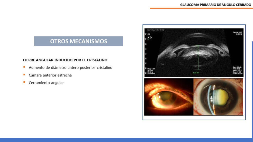 Actualizaci N De Glaucoma En Ngulo Cerrado Oftalmologo Quito Dr