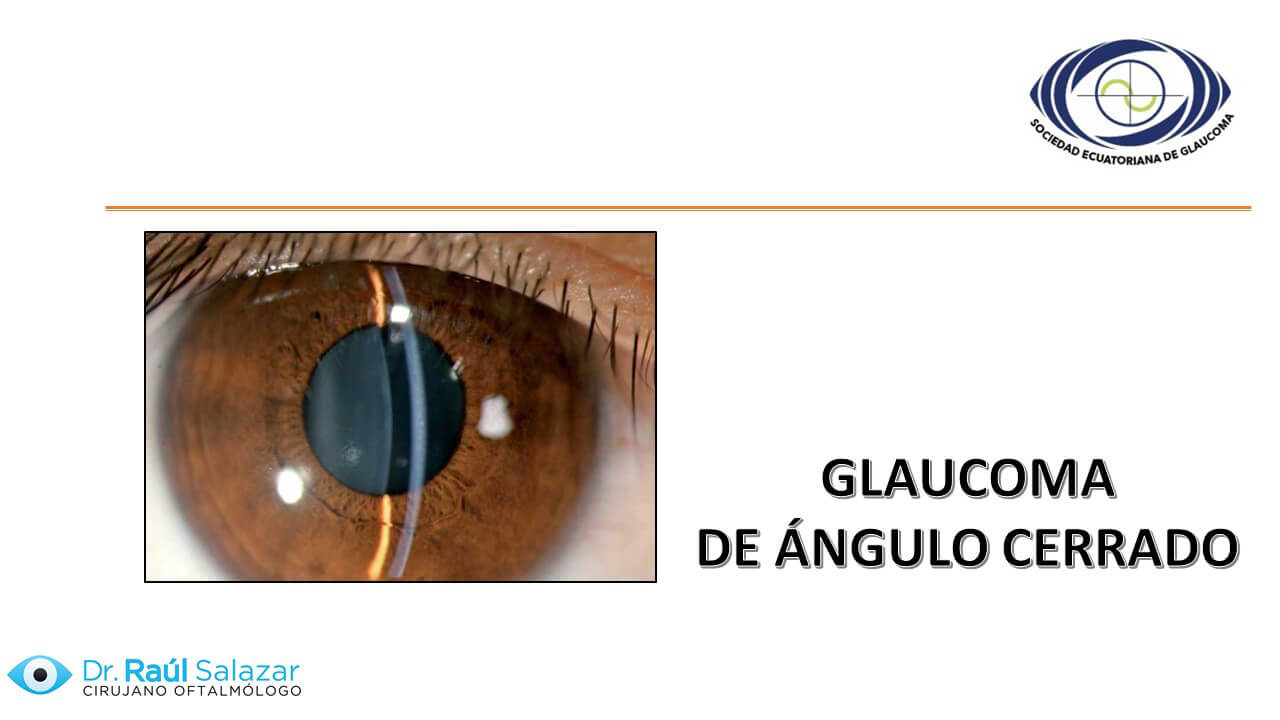 glaucoma agudo de ángulo cerrado