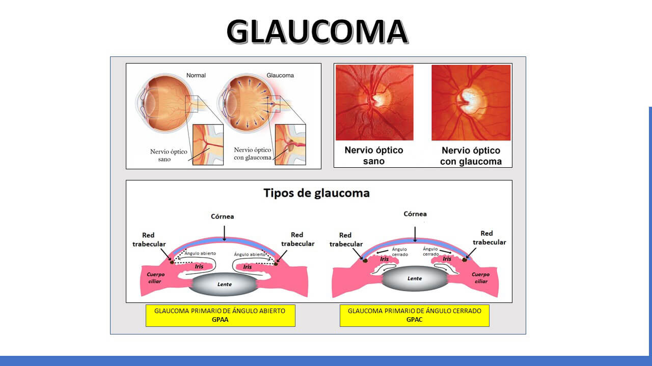 glaucoma agudo de ángulo cerrado