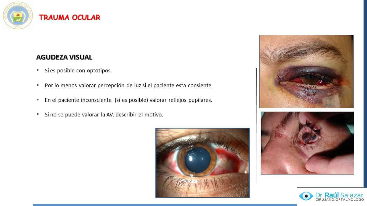 TRAUMA-OCULAR-Diapositiva13