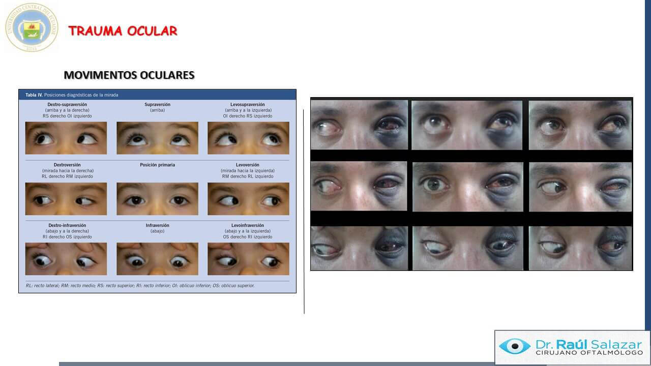 TRAUMA-OCULAR-Diapositiva17
