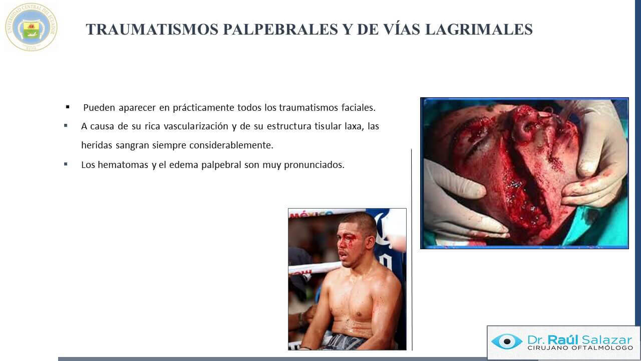 TRAUMA-OCULAR-Diapositiva26