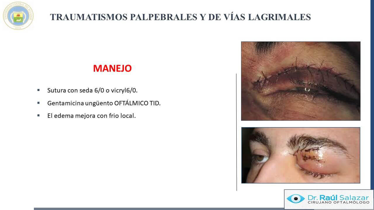 TRAUMA-OCULAR-Diapositiva28