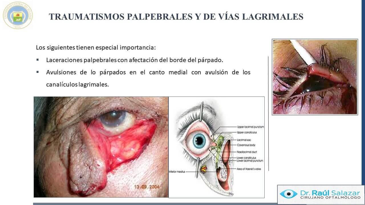 TRAUMA-OCULAR-Diapositiva29