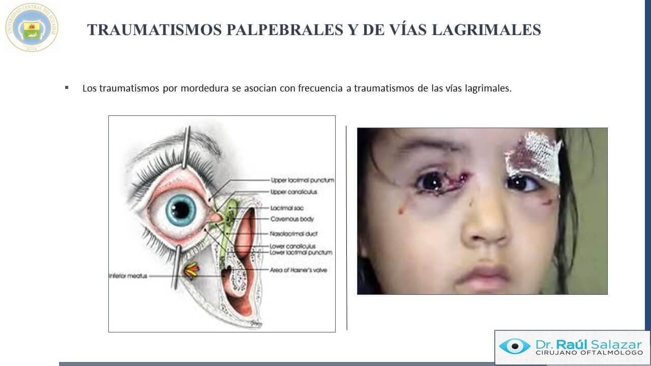 TRAUMA-OCULAR-Diapositiva30
