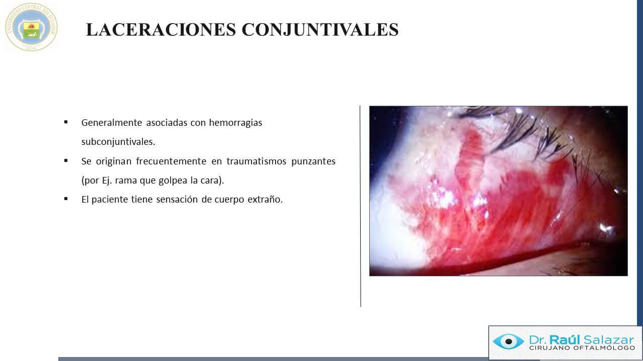 TRAUMA-OCULAR-Diapositiva33
