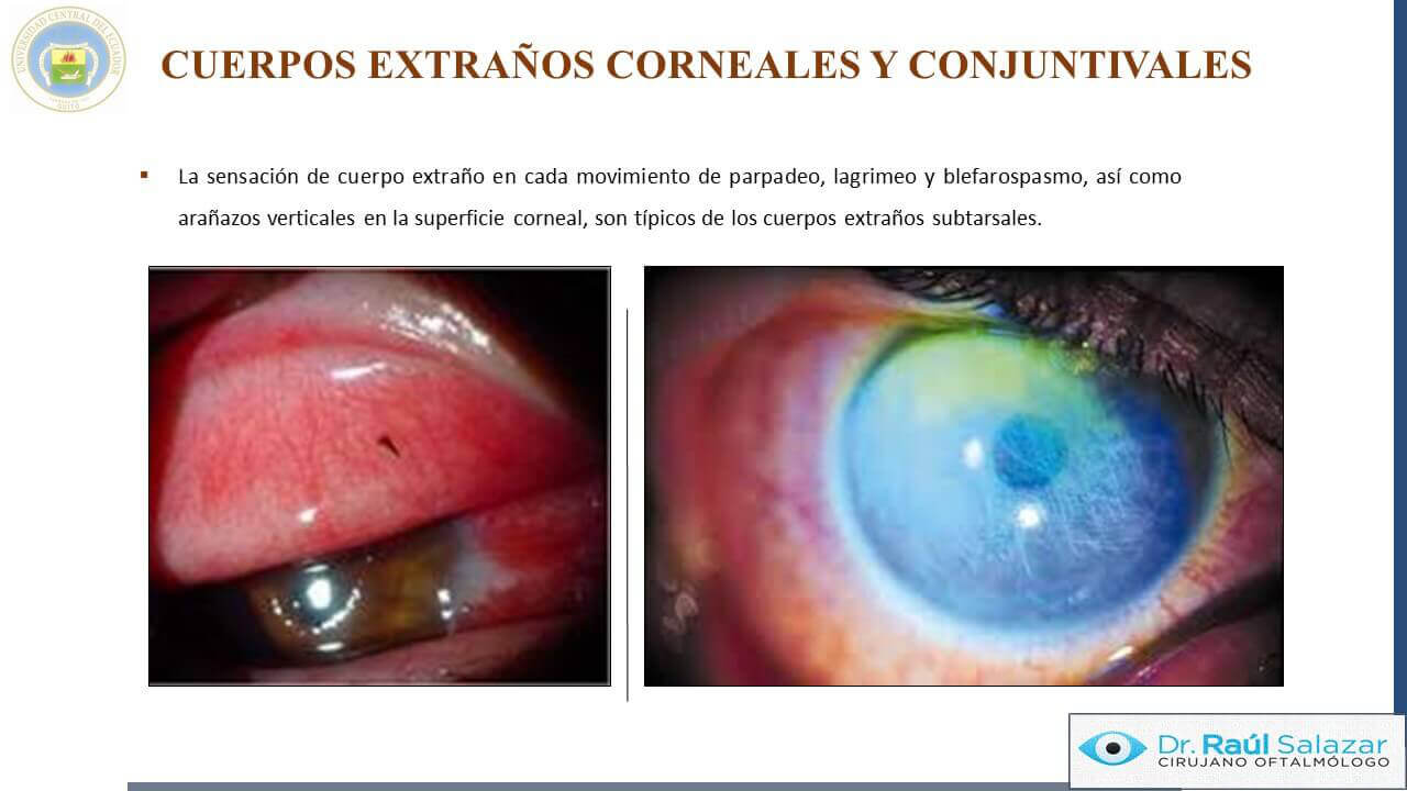 TRAUMA-OCULAR-Diapositiva37