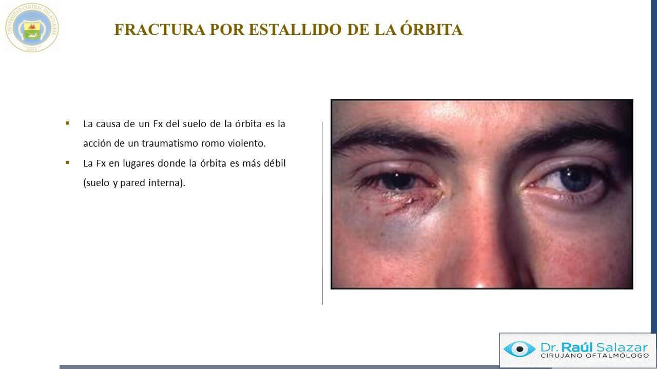 TRAUMA-OCULAR-Diapositiva44