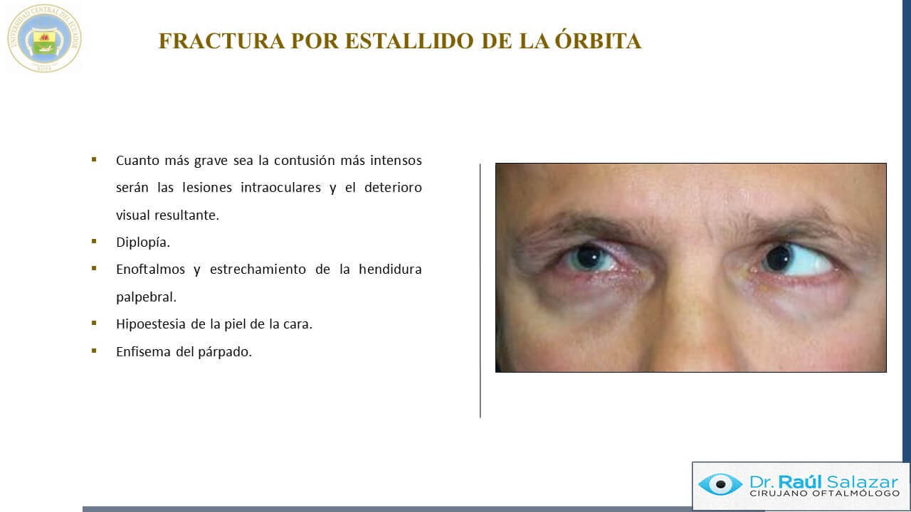 TRAUMA-OCULAR-Diapositiva45