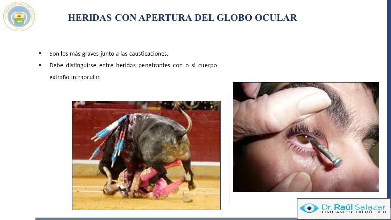 TRAUMA-OCULAR-Diapositiva50