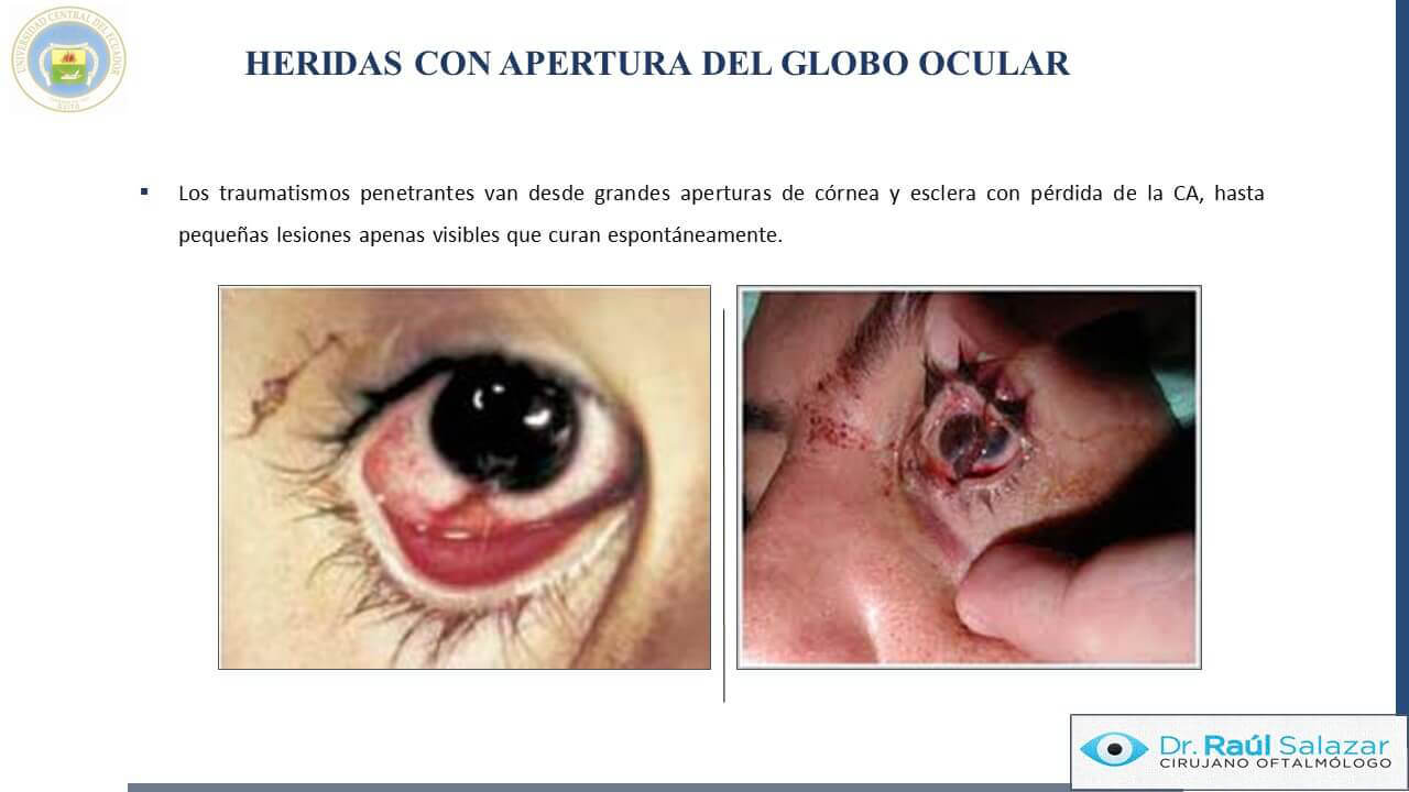 TRAUMA-OCULAR-Diapositiva51
