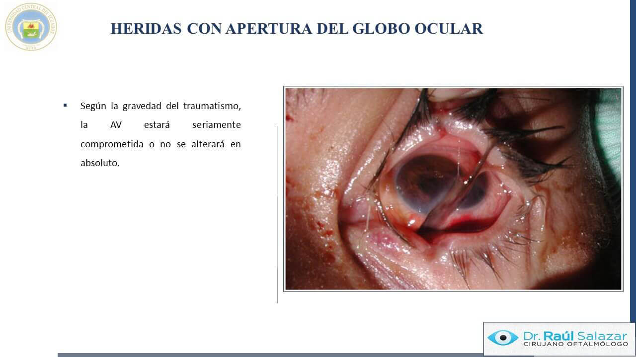 TRAUMA-OCULAR-Diapositiva52
