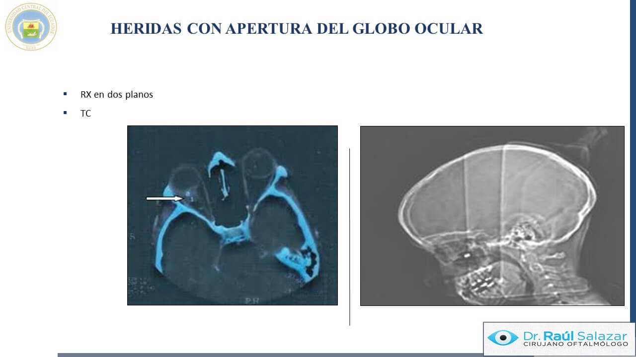 TRAUMA-OCULAR-Diapositiva53