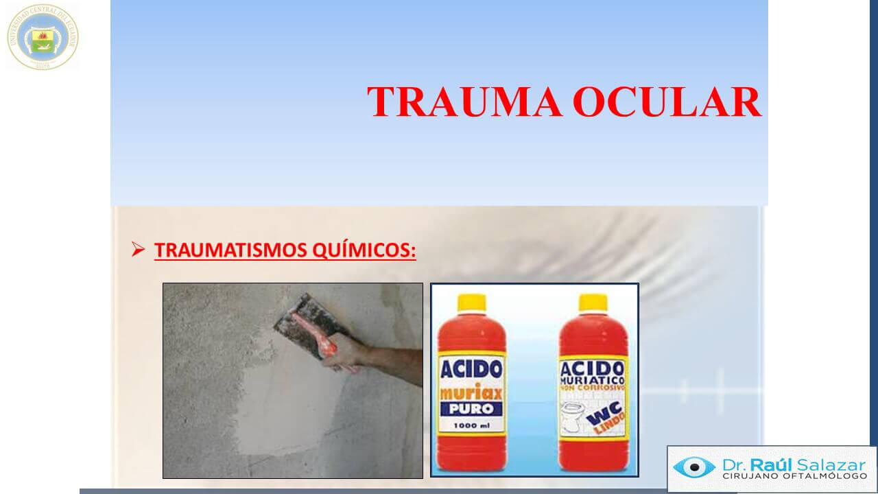 TRAUMA-OCULAR-Diapositiva58