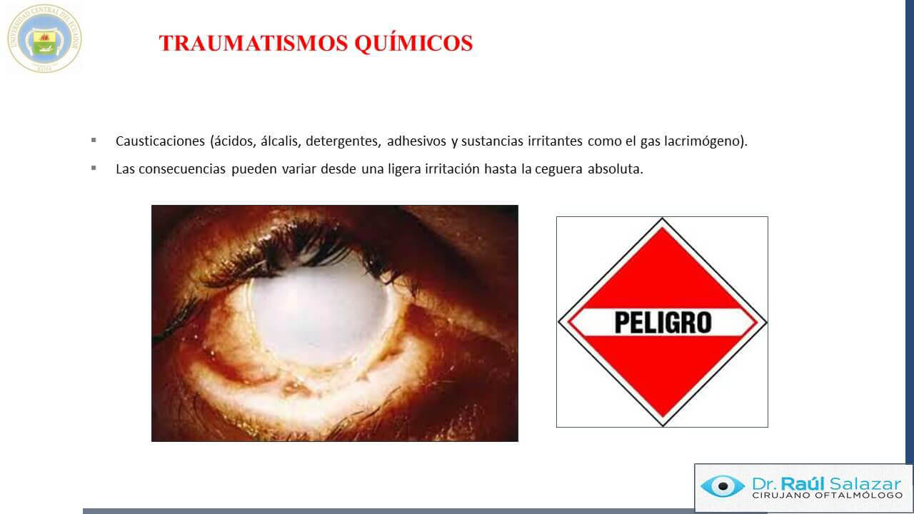 TRAUMA-OCULAR-Diapositiva59