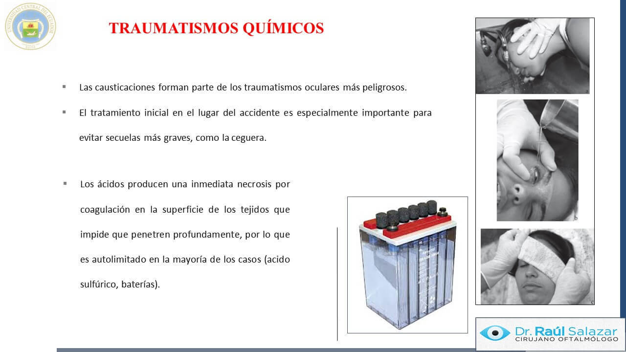 TRAUMA-OCULAR-Diapositiva60