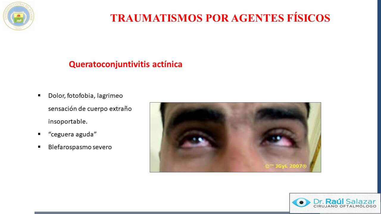 TRAUMA-OCULAR-Diapositiva67