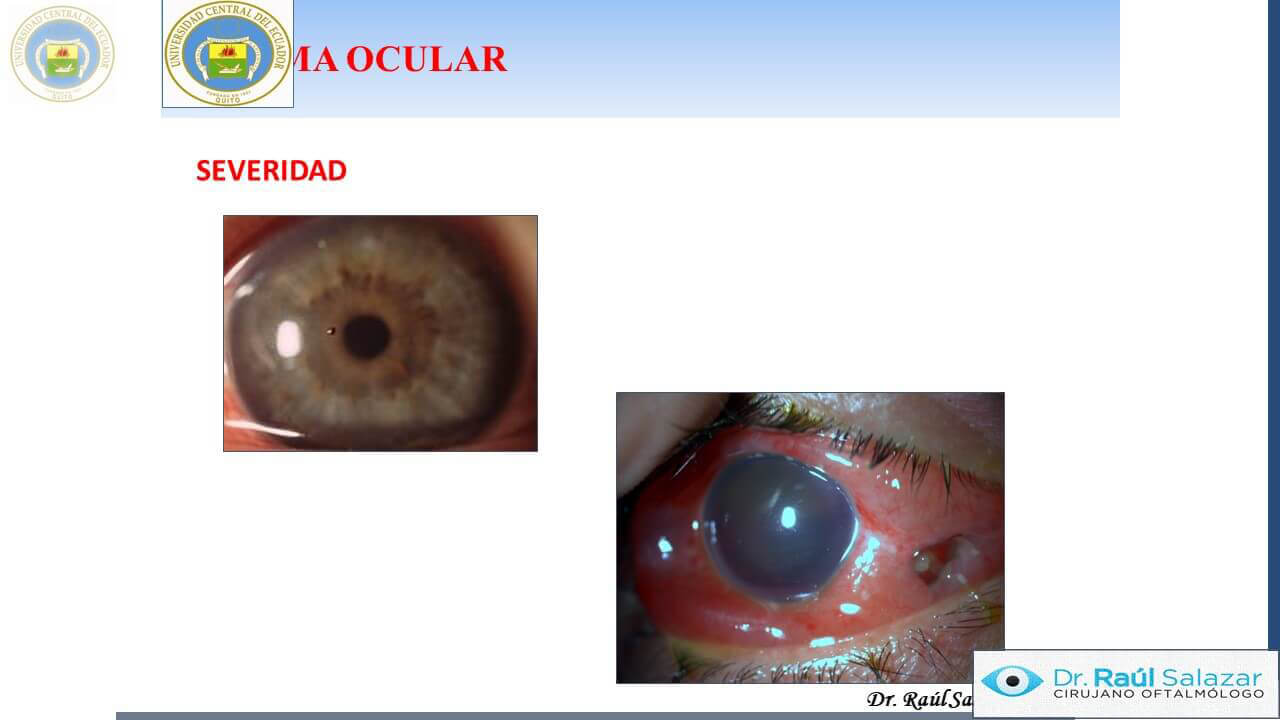 TRAUMA-OCULAR-Diapositiva8