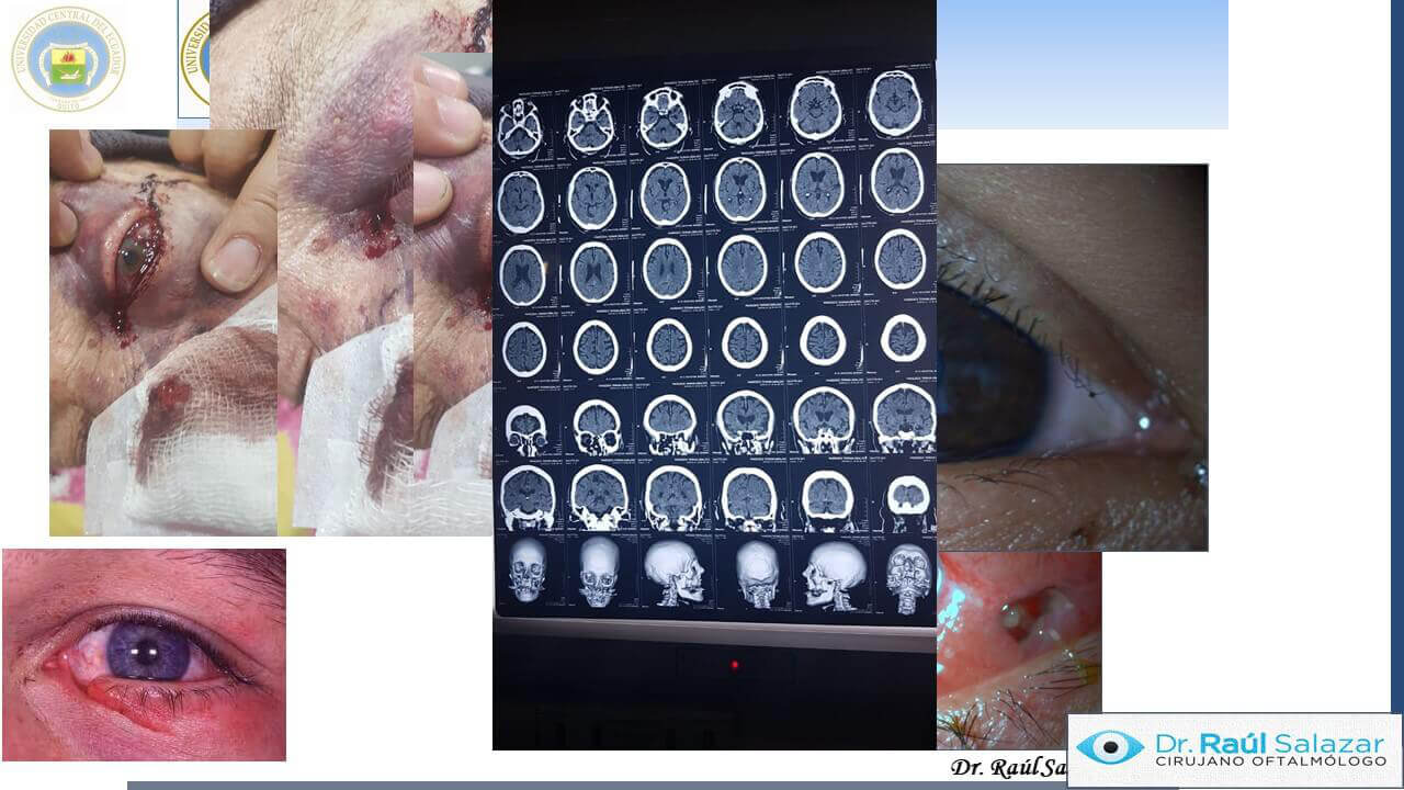 TRAUMA-OCULAR-Diapositiva9